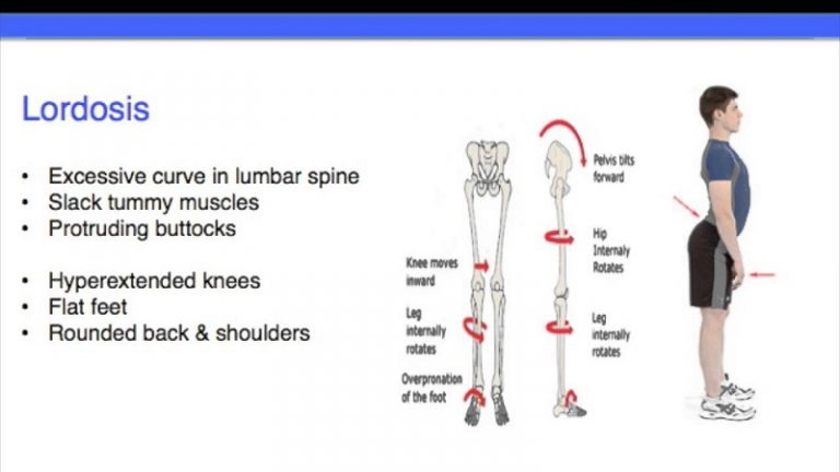 Lumbar Lordosis In Children: Causes And Treatment Of Exercises